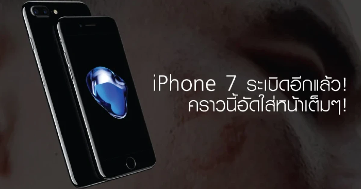 iPhone 7 ระเบิดอีกแล้ว คราวนี้อัดใส่หน้าเต็มๆ!